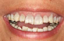 After crown lengthening Image