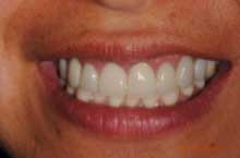 After restoration Image